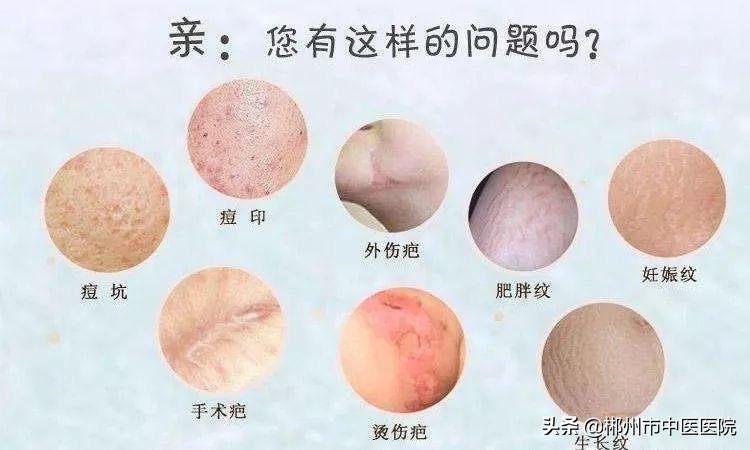 二氧化碳点阵激光靠谱嘛,二氧化碳点阵激光三个月后效果