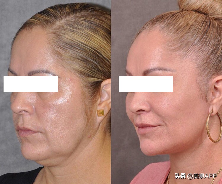 西京医院整形美容科面部年轻化,面部美容年轻化手术科普