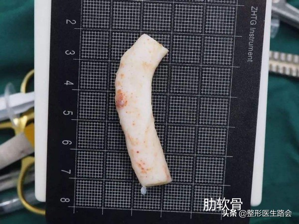 隆下巴硅胶和膨体哪个好,膨体隆下巴和硅胶隆下巴区别