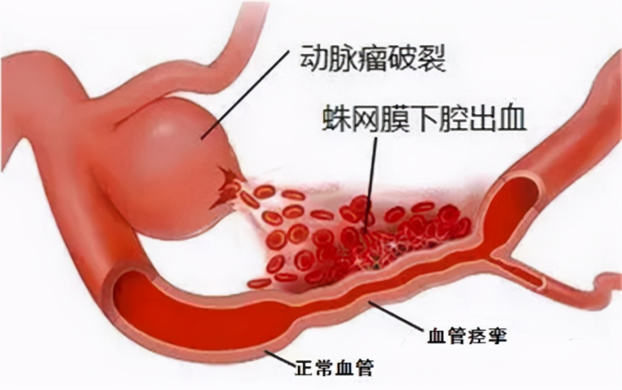 高血压脑出血急救视频,老年人突发脑出血应该怎么应急
