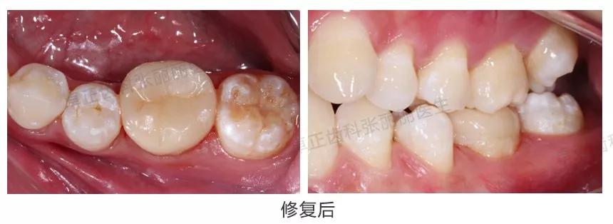 牙齿缺损全瓷冠修复多少钱,牙齿楔状缺损修复大概多少钱