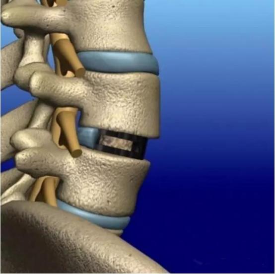 腰椎间盘突出针灸能治彻底吗,腰椎间盘突出针灸治疗能彻底吗