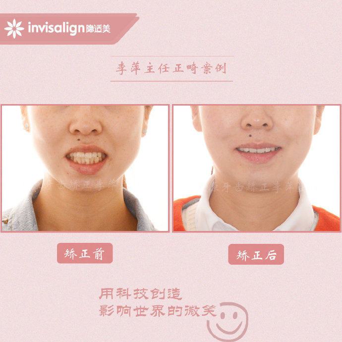 二甲医院骨性前突龅牙矫正多少钱,太原骨性嘴凸矫正牙齿图片