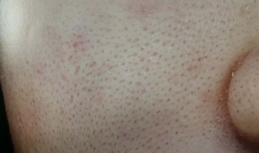 毛孔粗大最全攻略解决办法,毛孔粗大别担心记住这招全搞定