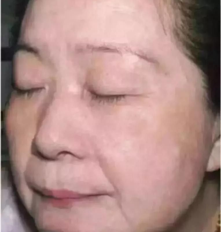 拯救痘痘烂脸用什么药,拯救痘痘烂脸这个小窍门你知道吗