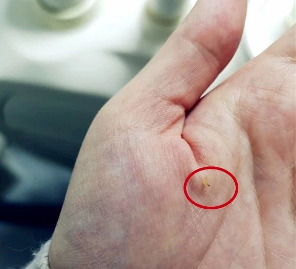 窝沟封闭预防龋齿会有什么危害吗,窝沟封闭后将有效预防孩子龋齿