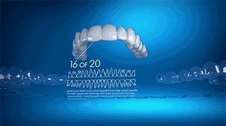 隐形牙套和透明保持器的区别,牙齿保持器和隐形牙套的区别