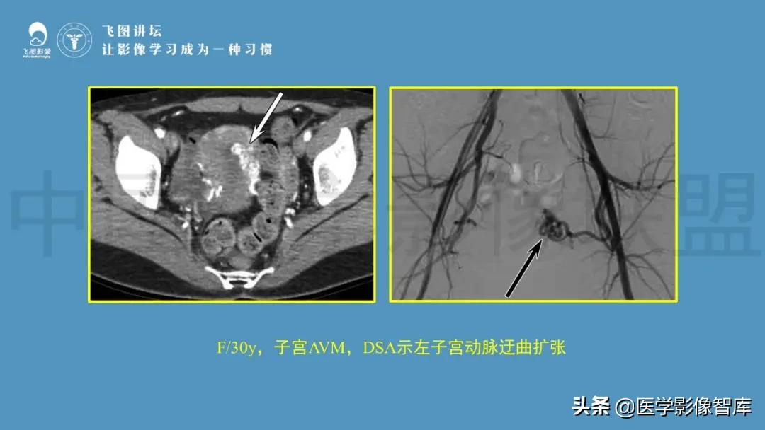 子宫解剖结构输卵管和卵巢位置,子宫附件ct影像学正常解剖表现