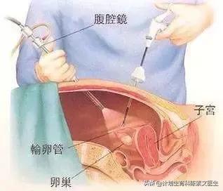 单孔腹腔镜包括哪些,3d腹腔镜与普通腹腔镜的开孔区别