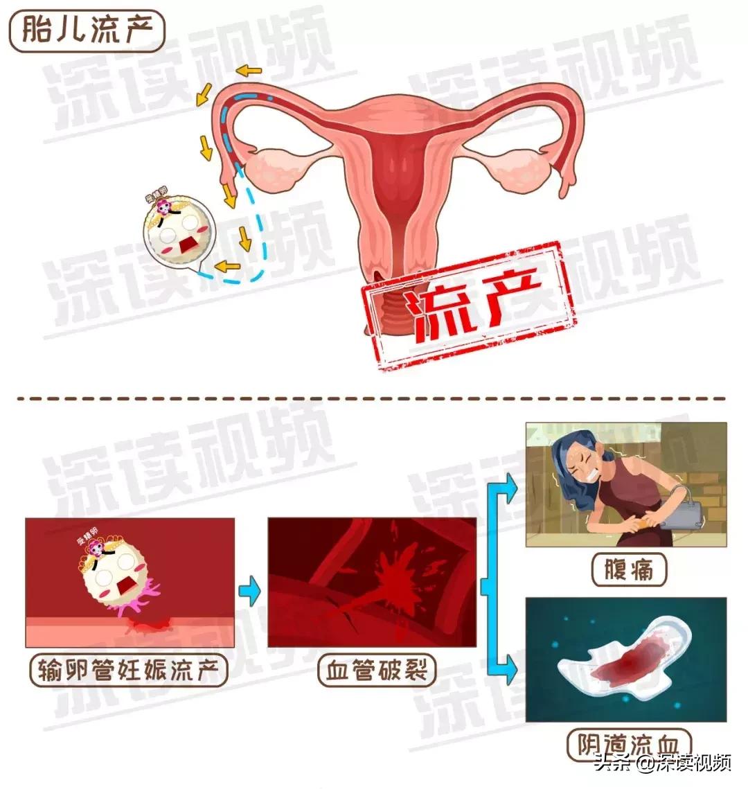 宫外孕有哪些习惯,怎样不容易宫外孕