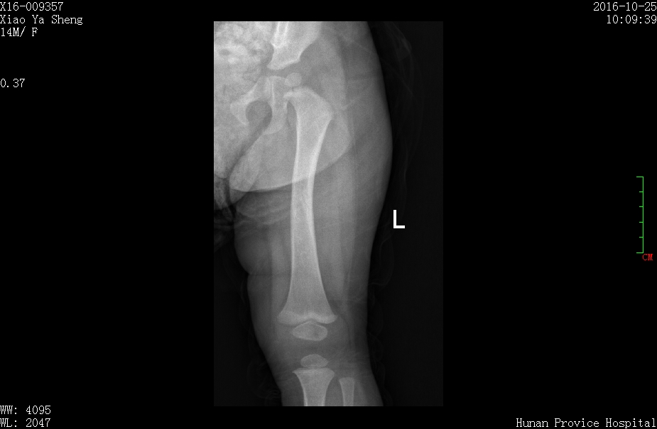 幼儿骨折误区,儿童骨折为什么好得快