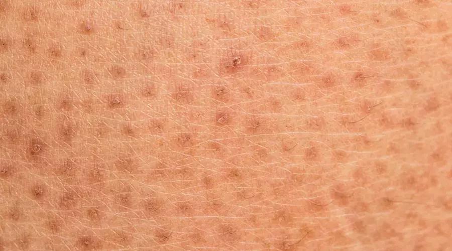 夏日不愁，4种方法拯救你的皮肤，和「鸡皮肤」说再见