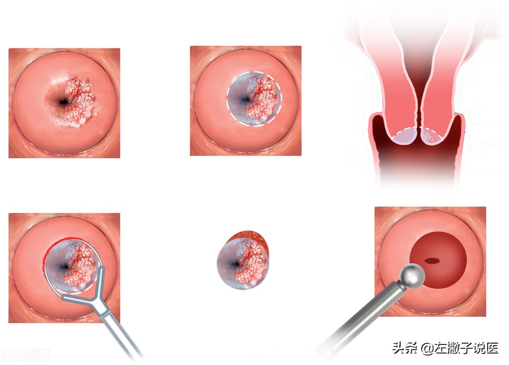 白带发臭一个多月了是宫颈癌吗,女人身体发臭什么病