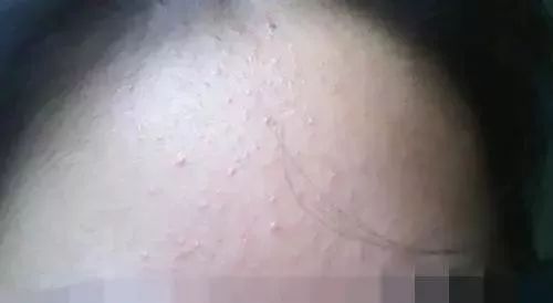 脂肪粒长在眼周围你应该这样做,眼睛周围的脂肪粒怎么快速消除