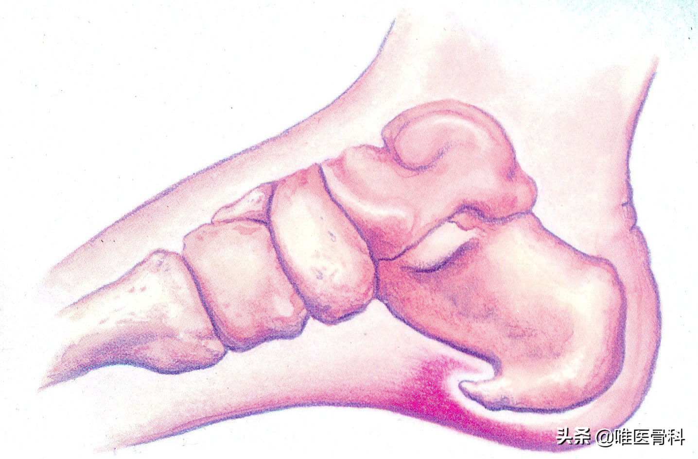 骨质增生引起的骨关节疼痛怎么治,30多岁退行性骨关节病怎么办