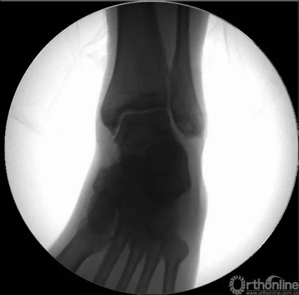 骨折闭合复位髓内钉内固定术,骨折闭合复位
