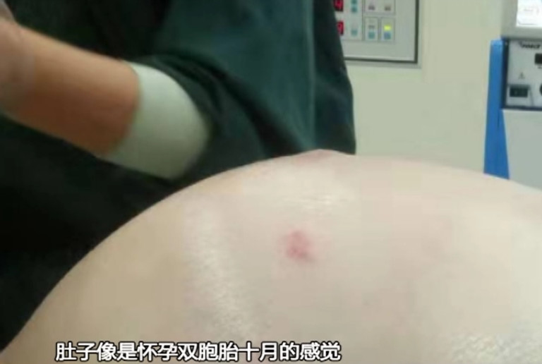 60多岁阿姨肚子大,60岁阿姨肚子忽然变大