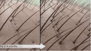 去头屑去螨虫哪个洗发水最有效,去头屑去螨虫用哪个洗发水最有效