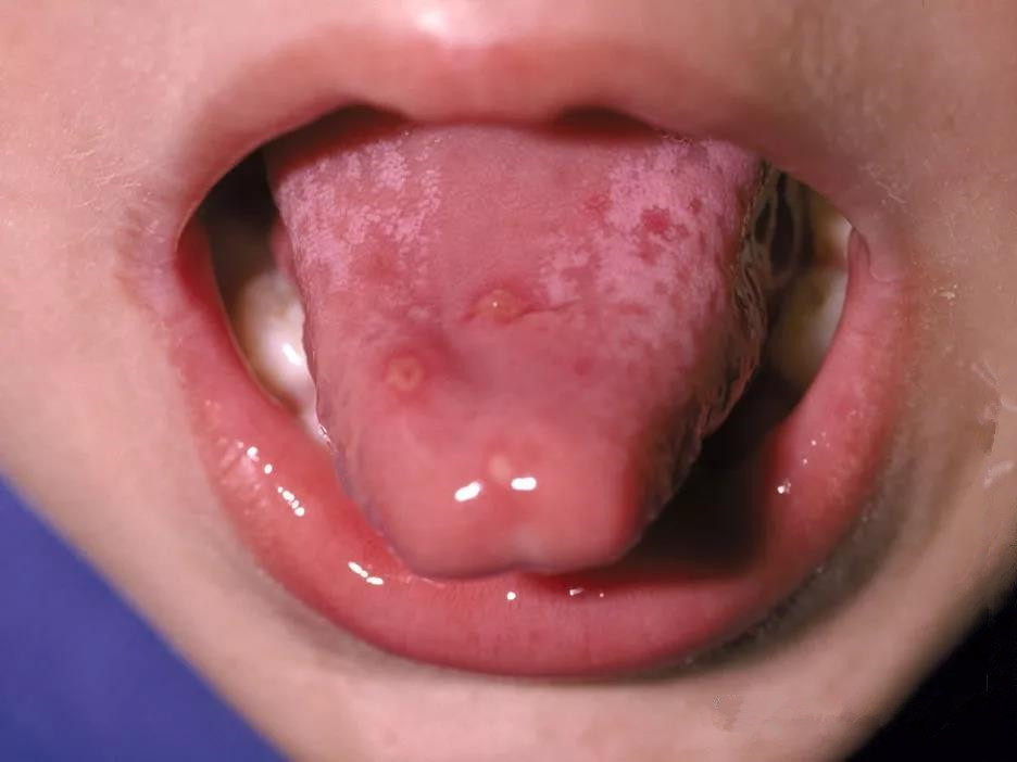 手足口病后期痊愈症状是什么,手足口病症状消失一般多少天