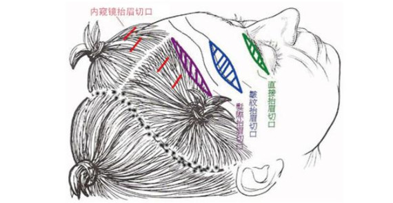 小拉皮和线雕哪个抗衰老效果好,最厉害的拉皮抗衰老技术