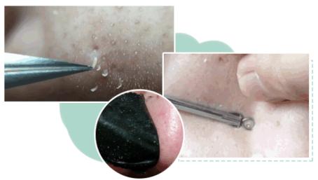 鼻子黑头怎么彻底解决,鼻子黑头最简单的消除方法