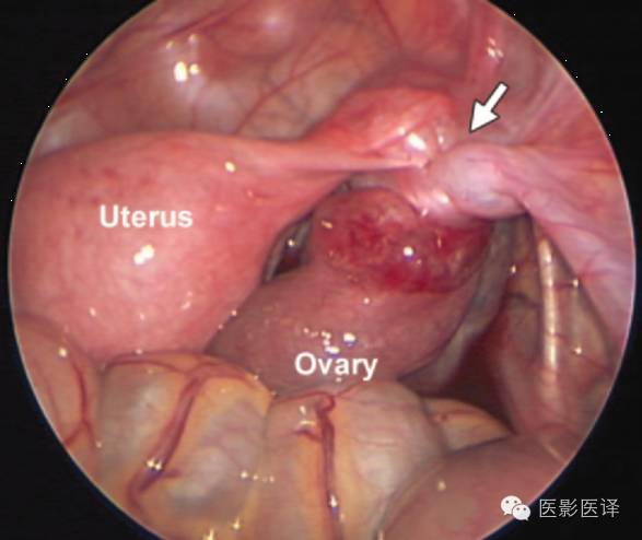 胎儿卵巢囊肿5.6厘米会消失吗,卵巢巨大囊肿与妊娠鉴别