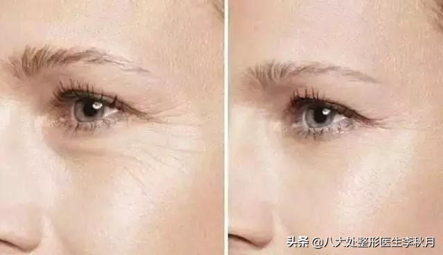 眼部细纹和眼袋泪沟怎么去除,赶走泪沟眼袋眼干没细纹