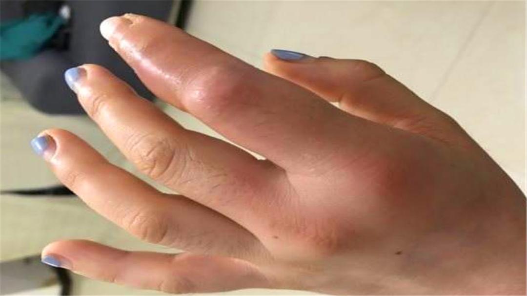 鱼刺扎伤手后感染的是什么菌,干鱼刺扎破手会感染细菌吗