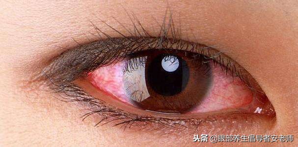 戴隐形眼镜后眼睛发红，小心可能是角膜炎