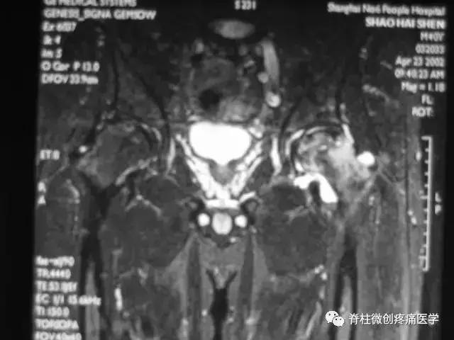 早期股骨头坏死核磁共振怎么看,股骨头坏死磁共振表现及分期