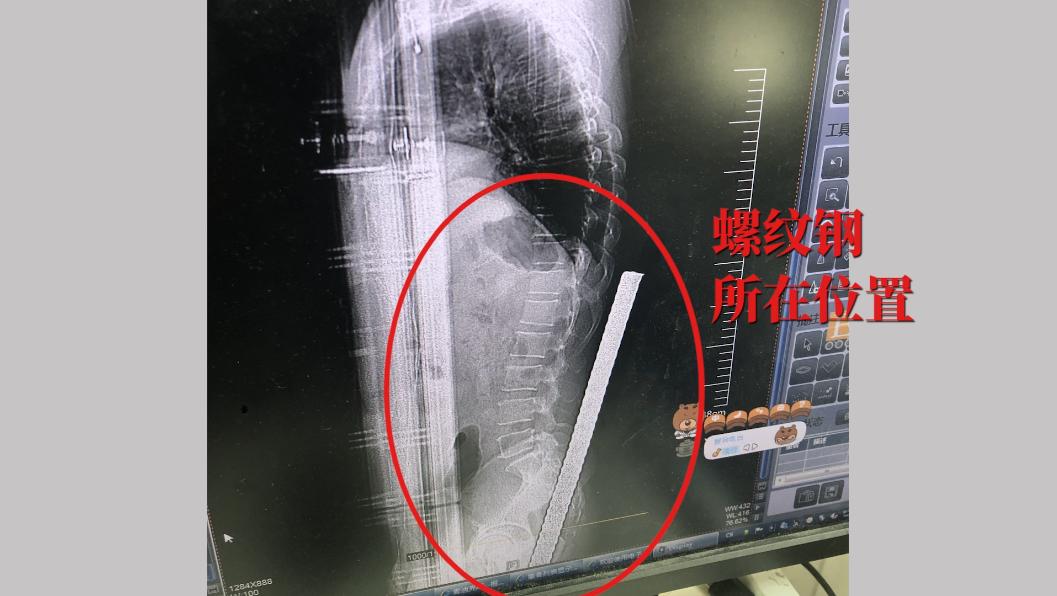 突发：90厘米长钢筋从会阴部插入穿腹入背结局：中大医院创伤中心多学科抢救化险为夷