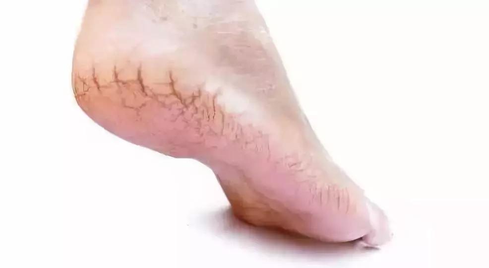 脚后跟像鱼鳞一样一层层干裂中医,脚后跟干裂腿部出现鱼鳞纹