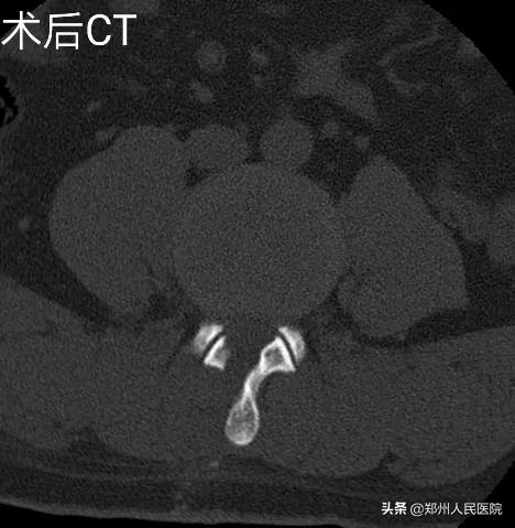 对骨科微创技术的认识,骨科手术与保守治疗对比
