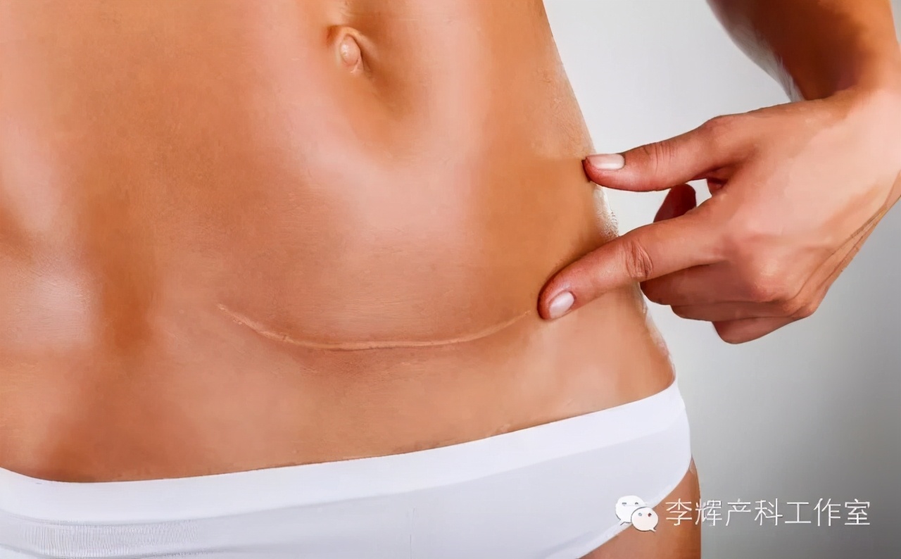 剖腹产腹壁切口内膜异位症,剖宫产后子宫内膜异位症怎么治疗