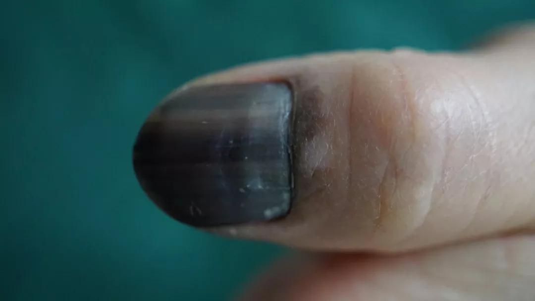 痣用点么,痣能点么