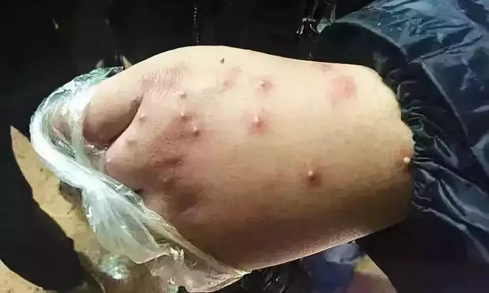 夏天最要小心这四种虫子,在外面遇到这种虫子千万别用手拍