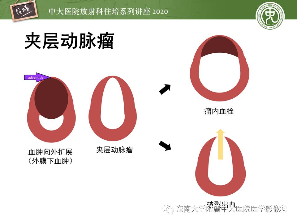 颈动脉夹层的超声表现及漏诊分析,动脉夹层与夹层动脉瘤是一样的吗