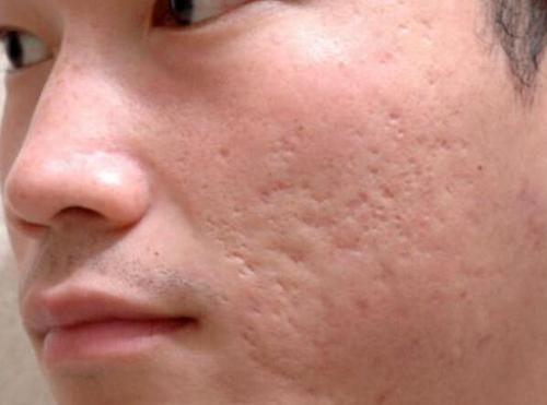 皮肤科医生怎么处理脸上痘痘,如何治疗脸上痘痘和疤痕