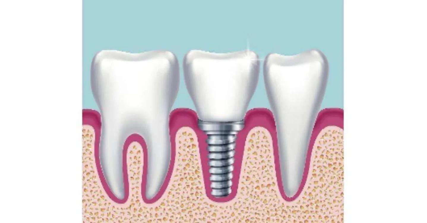 成年人牙齿破损还能长吗,成人牙齿坏了只剩牙根