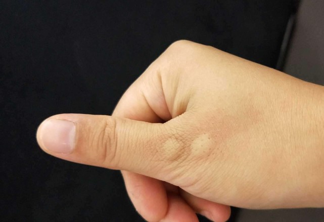 红霉素软膏治什么病最便宜,红霉素软膏价格不同效果不一样吗