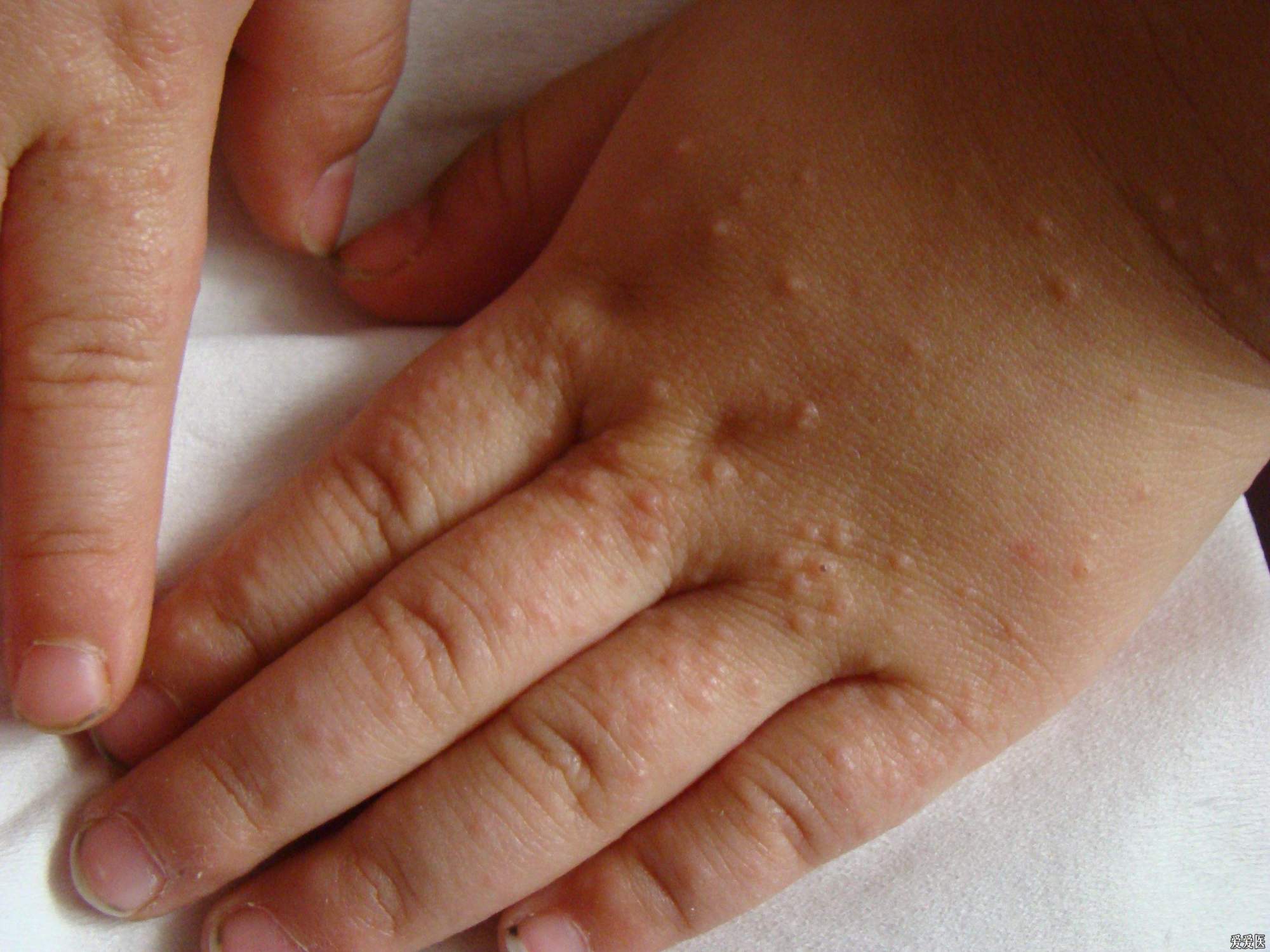 孩子湿疹痒老抓破皮肤怎么办,儿科医生皮肤湿疹