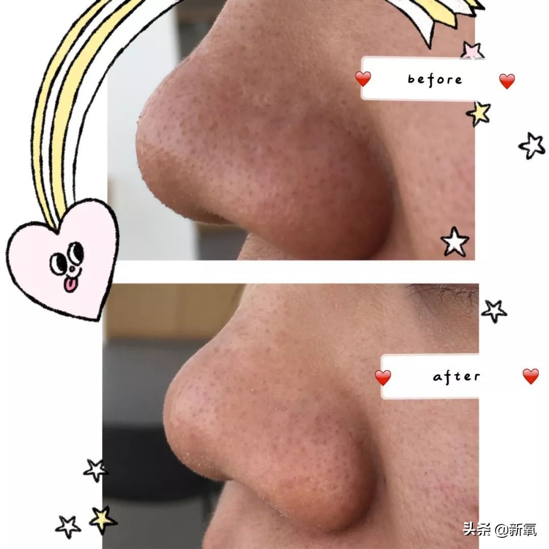 亲测非常有效的去黑头方法,去黑头最有效的方法三天见效