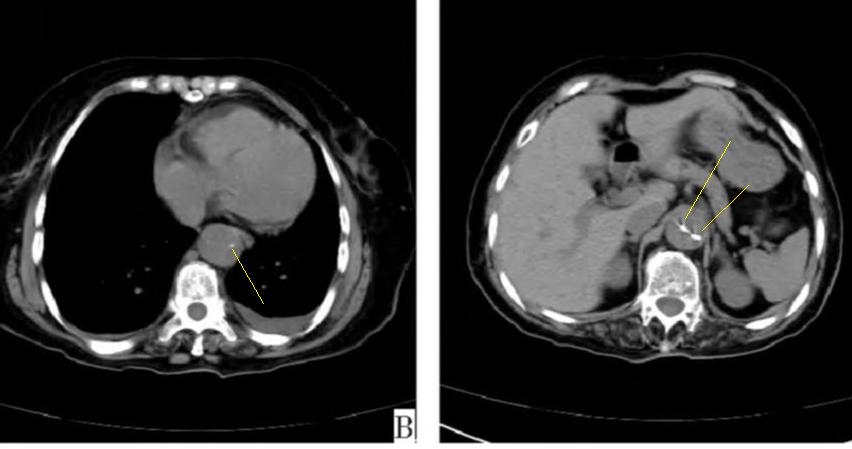 胸部Ct平扫能查出主动脉夹层吗,主动脉夹层cta影像图片解读