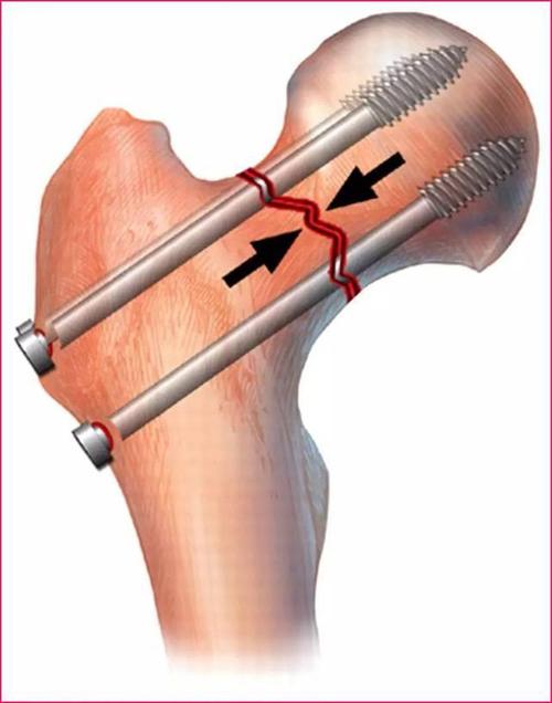老人胯骨骨折怎样缓解疼痛,80岁老人胯骨骨折错位怎么复位