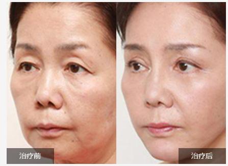 亳州利辛县热玛吉除皱术,亳州热玛吉除皱术