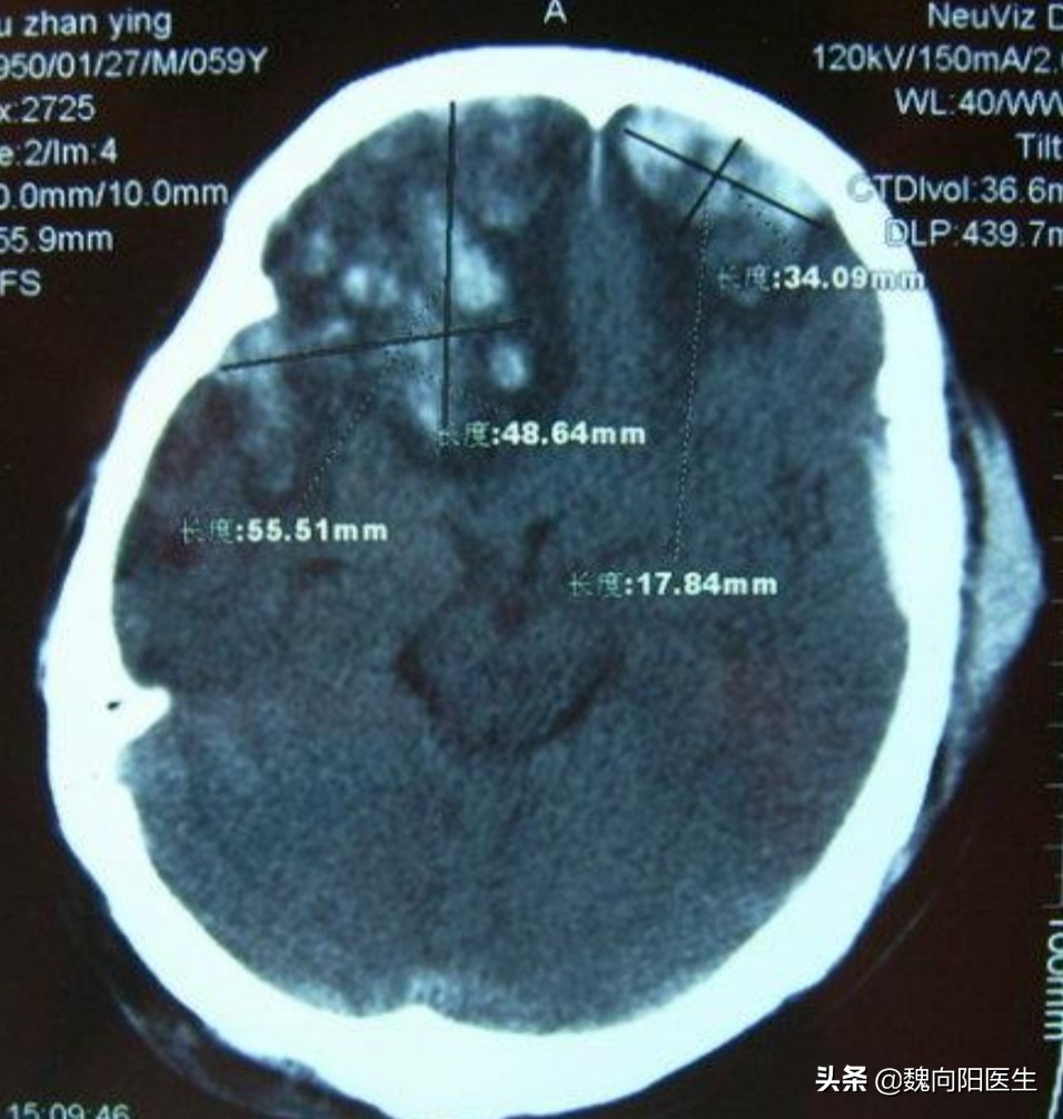 为什么后脑勺怕风,后脑勺着地好不好