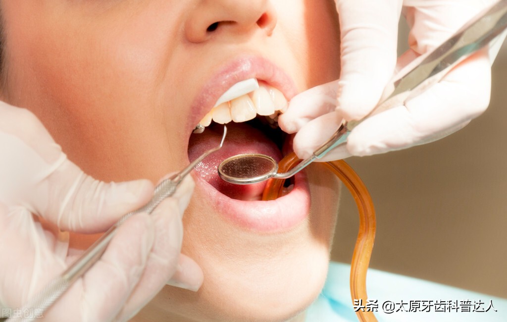 牙齿龋坏不痛可以不做根管,龋坏的牙齿自己掉后能补吗
