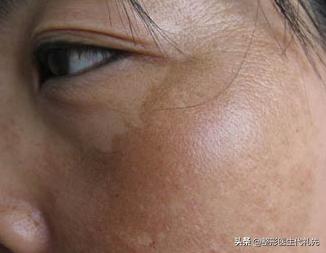 褐斑是什么病,褐斑形成原因