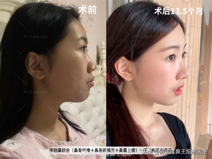 那些被鼻子“封印”颜值的鼻综合/修复案例|广州鼻整形