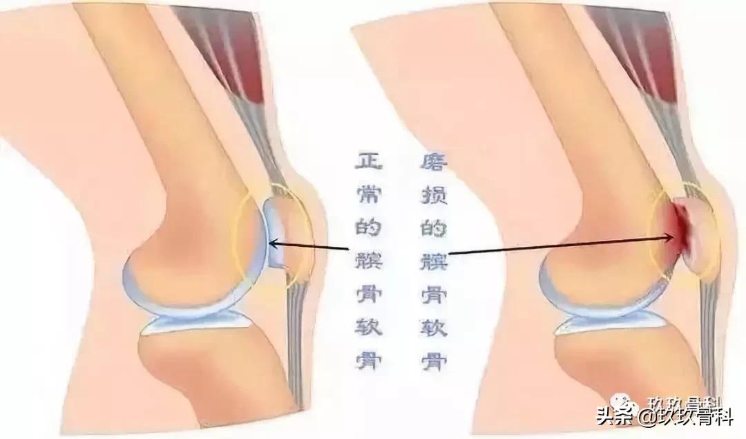 膝盖疼原来是腿向跑偏,膝盖走不准就疼一下是咋回事